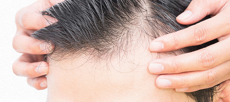 Haartransplantation ohne Rasur bei LH Aesthetic