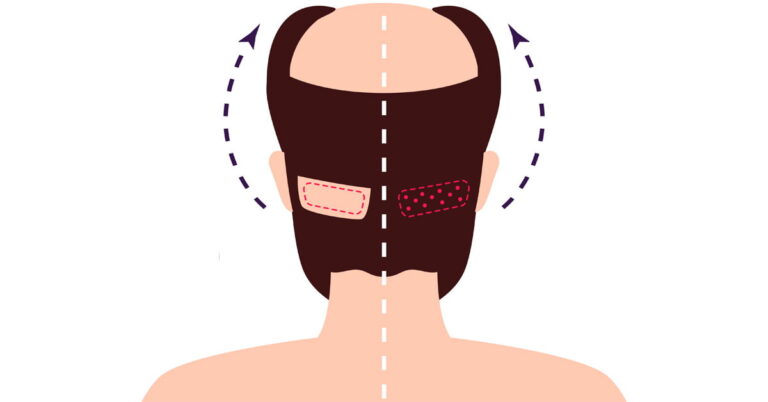 Hybride Haartransplantation bei LH Aesthetic