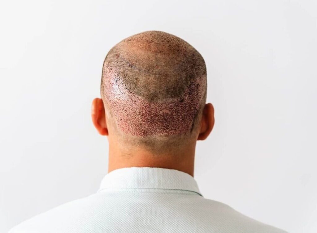 ZTF Haartransplantation bei LH Aesthetic