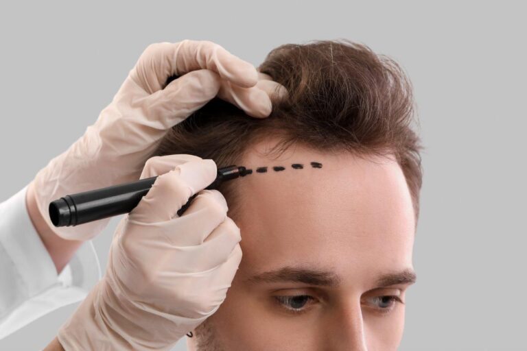 ZTF Haartransplantation bei LH Aesthetic
