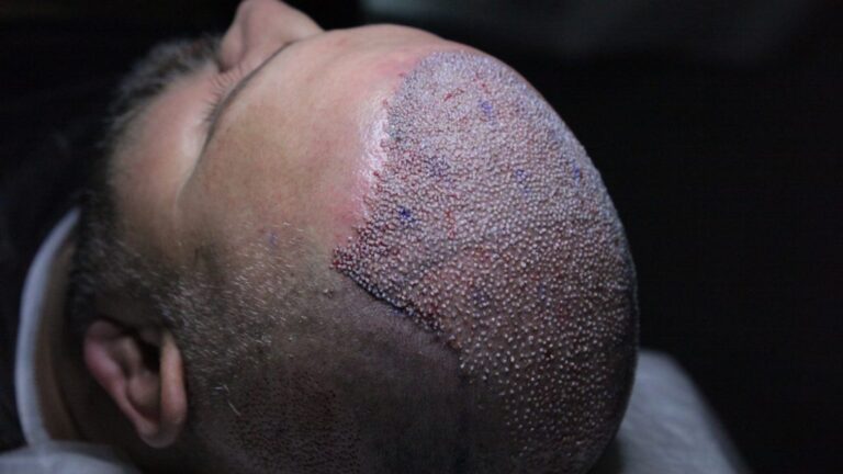 DHI Haartransplantation bei LH Aesthetic