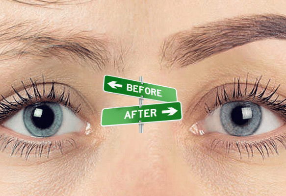 Augenbrauentransplantation bei LH Aesthetic