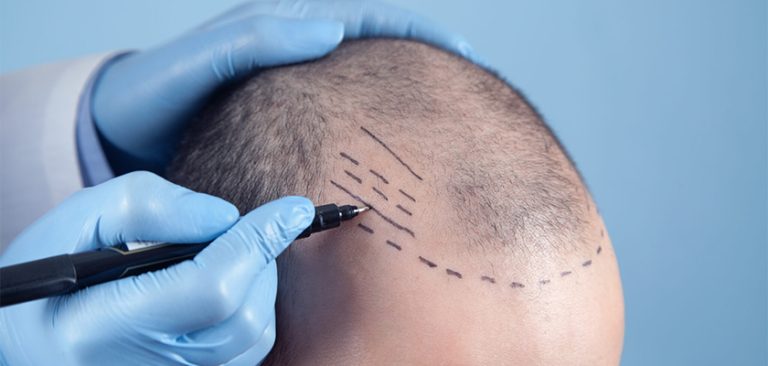 Saphir-FUE Haartransplantation bei LH Aesthetic