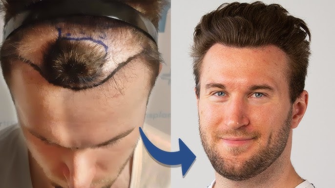 Lange Haartransplantation bei LH Aesthetic