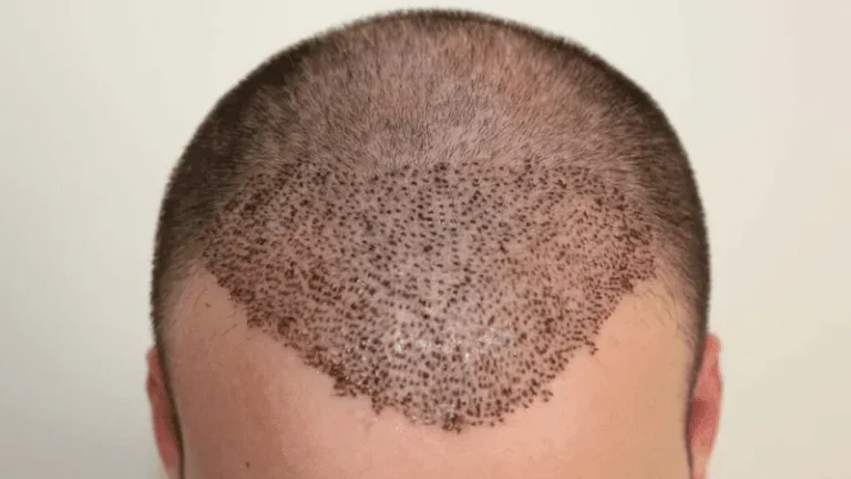 Haartransplantation bei LH Aesthetic