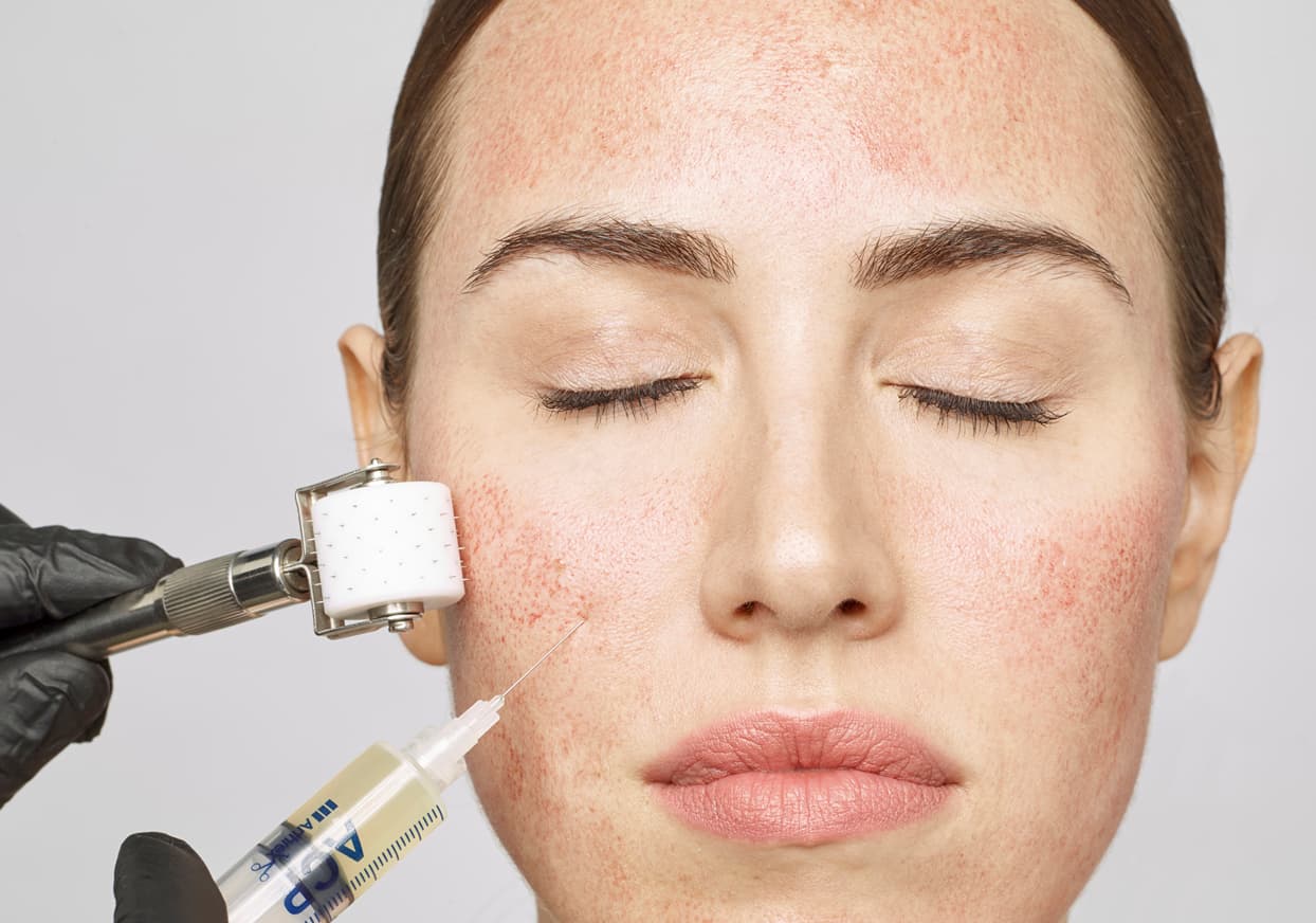 Vampir-Lifting (PRP) bei LH Aesthetic